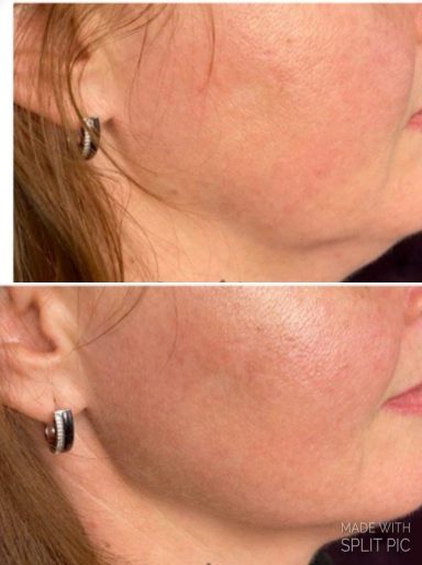 Kollagenostimulation Kollagenostimulation