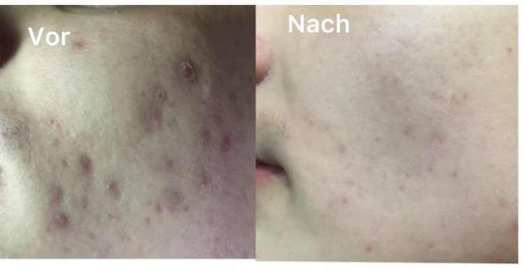 Gesichtsreinigung + Microneedling Gesichtsreinigung + Microneedling