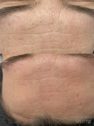 Kollagenostimulation nach eine Behandlung Kollagenostimulation nach eine Behandlung