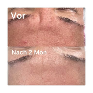 Gesichtsreinigung und Kollagenstimulation Gesichtsreinigung und Kollagenstimulation