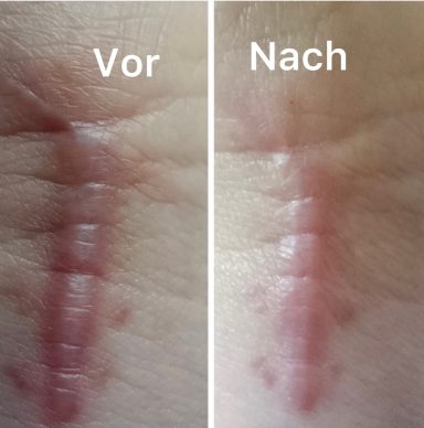Microneedling Microneedling