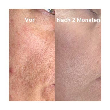 Gesichtsreinigung und KollagenstimulationGesichtsreinigung Gesichtsreinigung und Kollagenstimulation