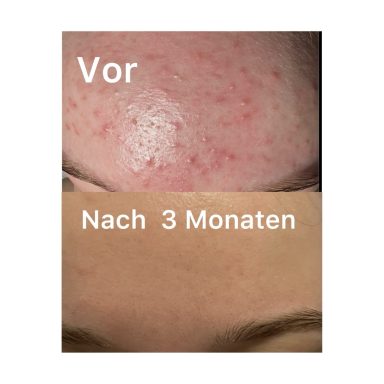 Gesichtsreinigung + Microneedling Gesichtsreinigung + Microneedling