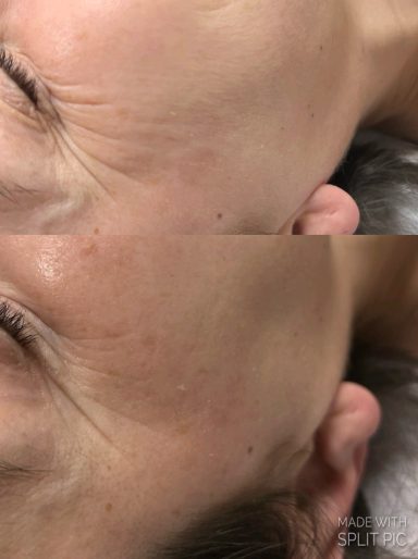 Kollagenostimulation Kollagenostimulation