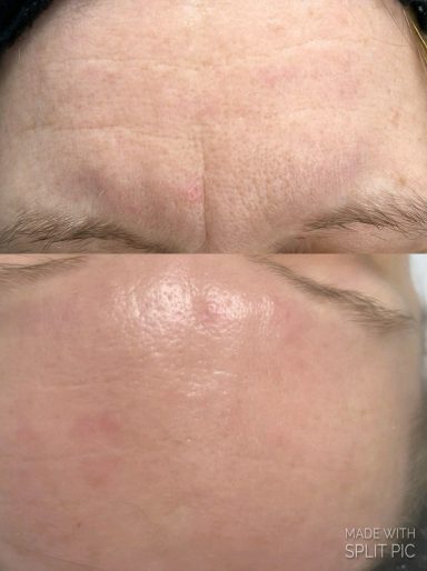 Kollagenostimulation Kollagenostimulation