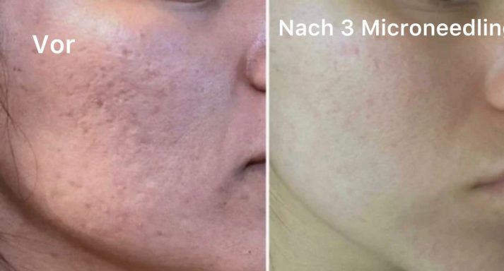 Microneedling Microneedling